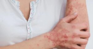 تهدئة نوبات الصدفية الحادة.. علاجات منزلية فعالة أقرها أطباء الجلدية