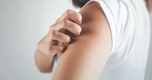 خمسة تعديلات غذائية للتحكم في أعراض الصدفية وتخفيف تهيج الجلد.