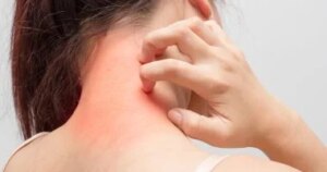 علاج الصدفية لم يعد يقتصر على الجلد.. خيارات حديثة تستهدف جذور المرض