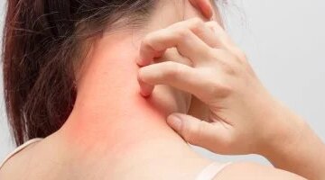 علاج الصدفية لم يعد يقتصر على الجلد خيارات حديثة تستهدف