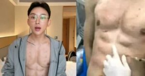 بعيداً عن الجيم.. مؤثر صيني يدفع 560 ألف دولار مقابل عضلات بطن وهمية بالهيالورونيك.