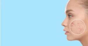 حب الشباب بعد الثلاثين: حين تكون الهرمونات هي المتهم الأول وليس إهمال البشرة.