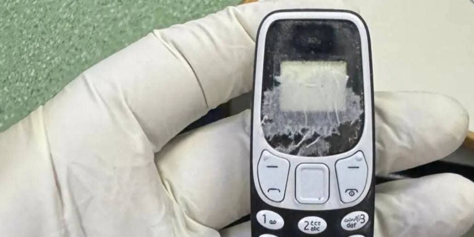 استخراج هاتف محمول من بطن مريض بعد 11 شهرا بمركز الجهاز الهضمي بالمنصورة