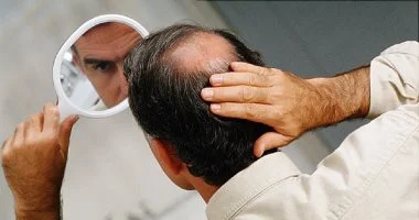 علاج الصلع في 20 يومًا.. دراسة تكشف عن مصل يعيد إنبات الشعر بفعالية قياسية