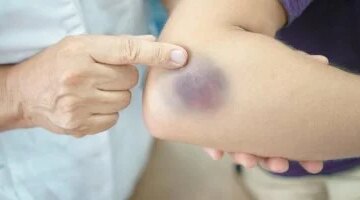 كدمات مرضى السكري ارتباط مباشر بتلف الأوعية الدموية ومؤشر على