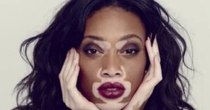 ليست كل بقعة بيضاء بهاق.. طبيب يحدد العلامات الفارقة لتشخيصها بدقة