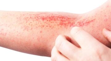 5 أعراض جلدية مؤشرات تنذر بخطر إصابة الكبد وتستوجب زيارة