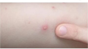 سلالة جديدة متحورة تحذير عاجل من الصحة العالمية حول انتشار