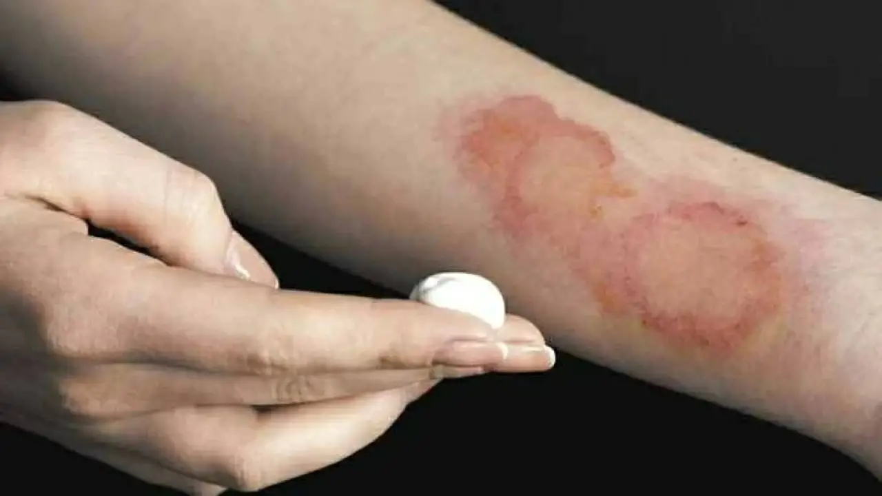 تجنباً للندوب الدائمة.. خطأ شائع في علاج الحروق يهدد جلدك بمضاعفات خطيرة