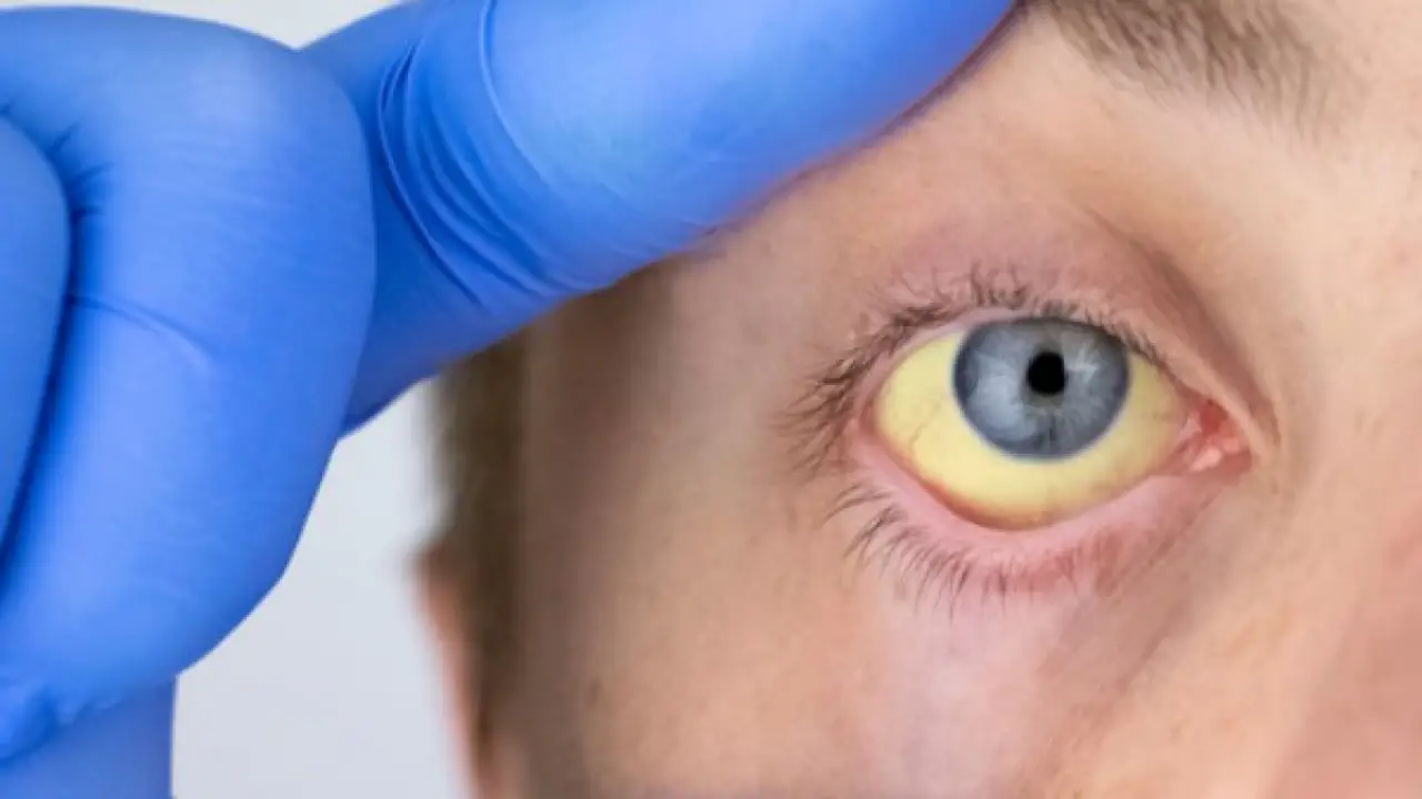 قاتل صامت.. علامات غامضة تكشف إصابتك بالتهاب الكبد رغم غياب الأعراض الواضحة