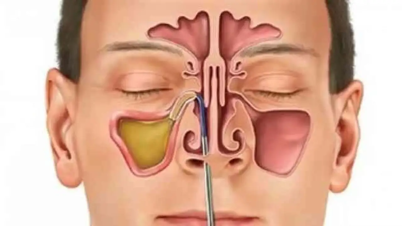 تحذير لمرضى الجيوب الأنفية.. عرض صامت يكشف تطورات خطيرة تتطلب التدخل الفوري