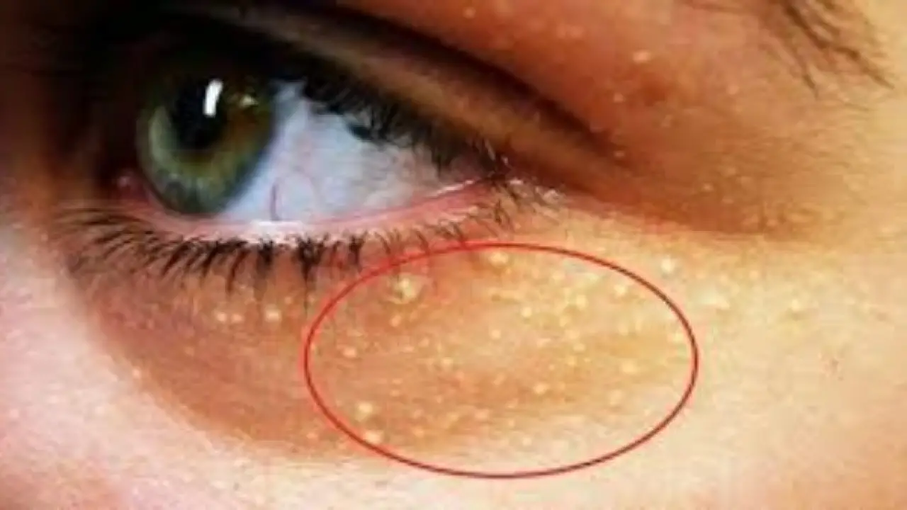 تحذير طبي.. علامات خفية تظهر على الوجه تنذر بارتفاع صامت في الكوليسترول