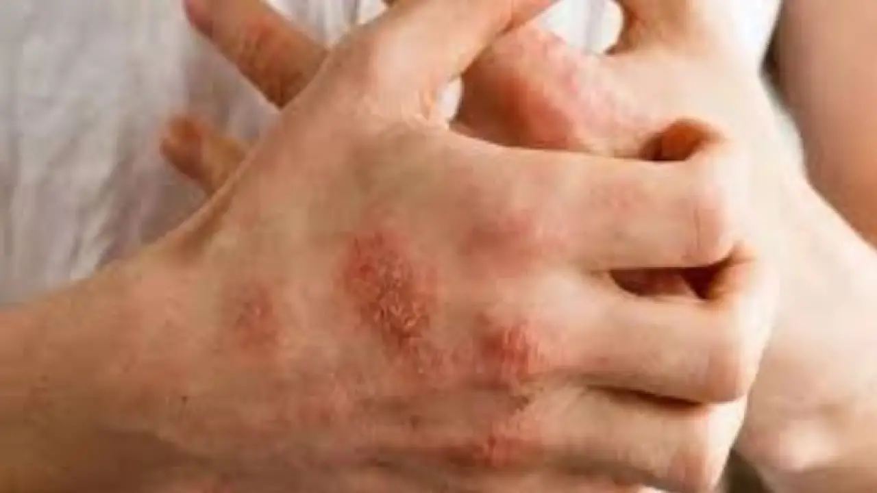 جوزة الطيب.. سر طبيعي ينهي معاناة مرضى الإيكزيما ويحسم صراع الحكة المستمر