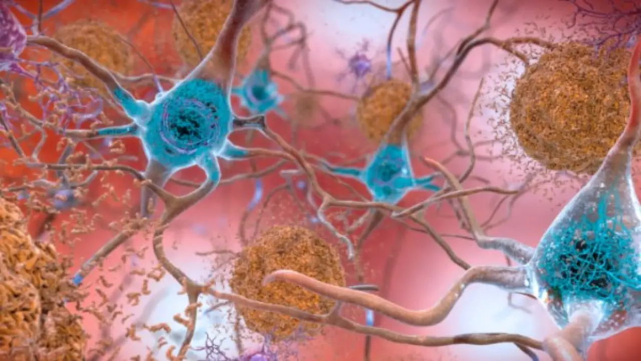 خطر يهدد الذاكرة.. تحذير طبي يحسم علاقة أعراض كوفيد الطويلة بمرض الزهايمر