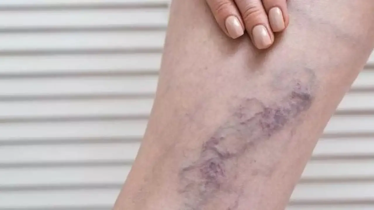 أوجاع الساقين.. علامة خفية تحذر من خطر داهم يستوجب التدخل الجراحي الفوري