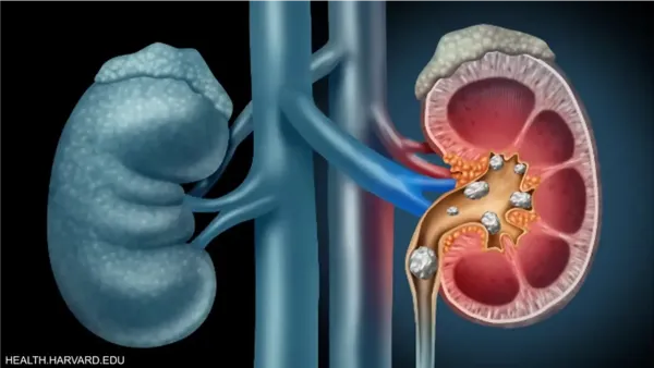أداة الذكاء الاصطناعي BMVision تسرّع تشخيص سرطان الكلى بنسبة تقليل زمن التحليل إلى الثلث