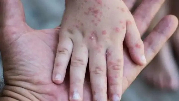 الحساسية الحشرية والجدري المائي: كيف تميز بين الطفح الجلدي في الوجه والأطراف؟