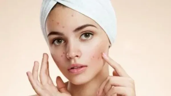 السيطرة على حب الشباب الموسمي.. 5 تعديلات بسيطة يوصي بها أطباء الجلدية