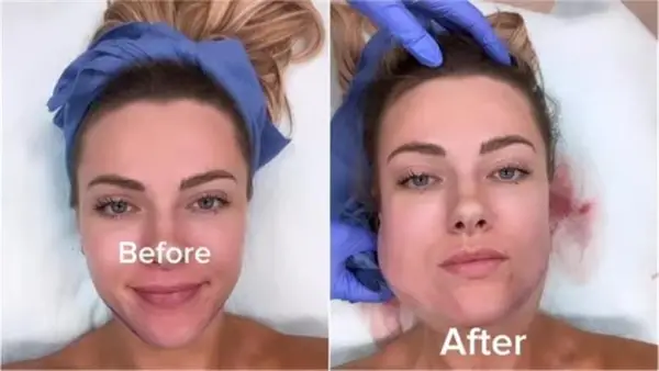 تحذير إبسن بروك.. كيف دمرت عمليات التجميل ملامح الفتاة بسبب هوس الفلاتر؟