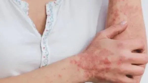 تهدئة نوبات الصدفية الحادة.. علاجات منزلية فعالة أقرها أطباء الجلدية