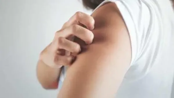 خمسة تعديلات غذائية للتحكم في أعراض الصدفية وتخفيف تهيج الجلد.