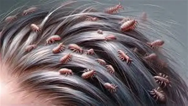 رؤى غير متوقعة.. دلالات ظهور القمل في الشعر وتأثيرها على حالتك النفسية