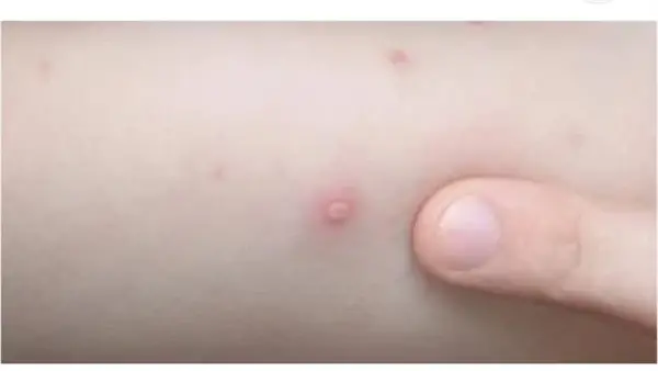 سلالة جديدة متحورة.. تحذير عاجل من الصحة العالمية حول انتشار جدري القرود بالدول