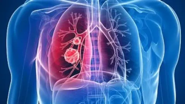 قبل السعال.. سرطان الرئة قد يطلق أولى تحذيراته من ساقيك.
