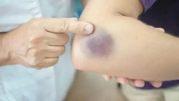 كدمات مرضى السكري: ارتباط مباشر بتلف الأوعية الدموية ومؤشر على ضعف التحكم بالمرض.