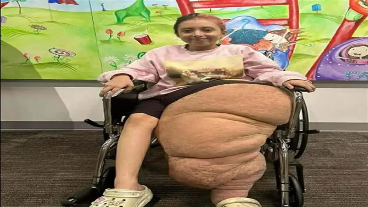 متلازمة كليبل ترينوناي تؤثر على نمو ساق «جاسمين» وتستدعي سلسلة جراحات لتقويم الحالة