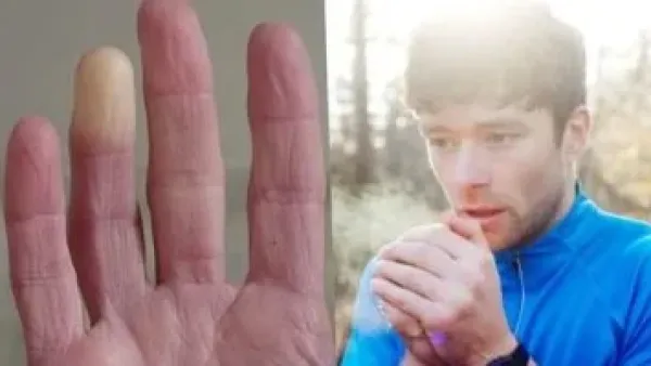 مرضى الأمراض المزمنة: كيف يحول الشتاء نزلات البرد العادية إلى أزمة صحية خطيرة؟