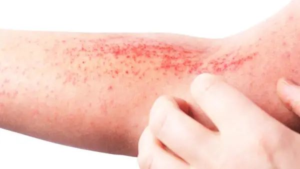 5 أعراض جلدية.. مؤشرات تنذر بخطر إصابة الكبد وتستوجب زيارة الطبيب فورًا