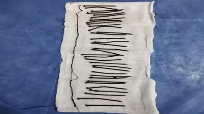 34 مسماراً.. الطب النفسي يوضح دوافع سيدة كفر الشيخ بعد إنقاذ حياتها