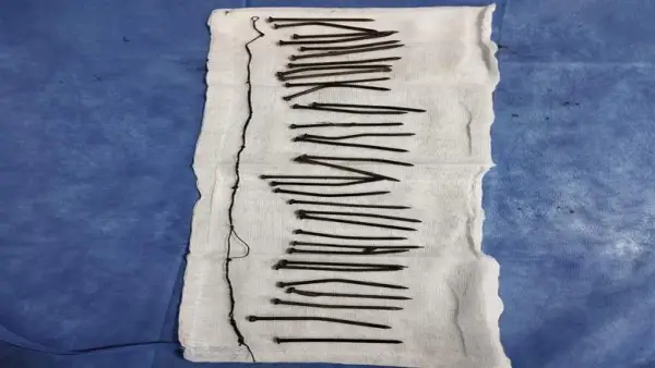 34 مسماراً.. الطب النفسي يوضح دوافع سيدة كفر الشيخ بعد إنقاذ حياتها