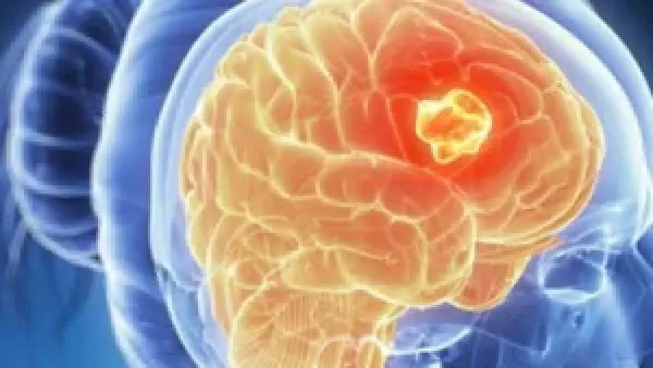 التنبؤ بشراسة الورم السرطاني يحدد مسار انتشار المرض بدقة باستخدام الذكاء الاصطناعي