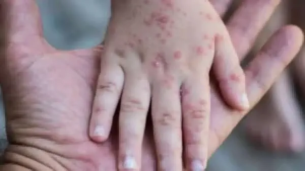 الحساسية الحشرية والجدري المائي: كيف تميز بين الطفح الجلدي في الوجه والأطراف؟