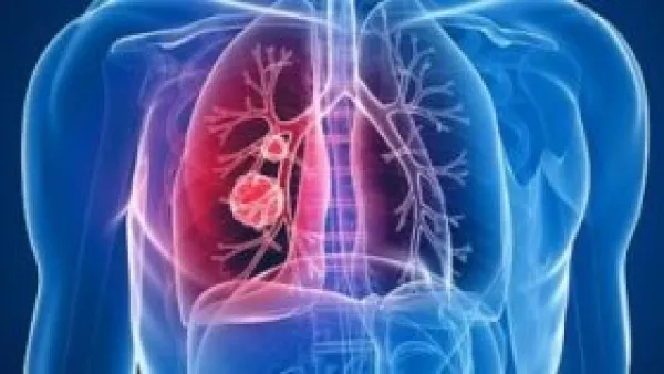 قبل السعال.. سرطان الرئة قد يطلق أولى تحذيراته من ساقيك.