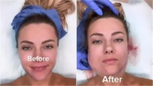 تحذير إبسن بروك.. كيف دمرت عمليات التجميل ملامح الفتاة بسبب هوس الفلاتر؟