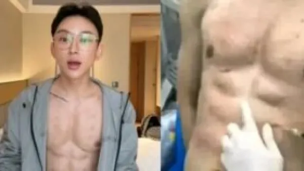 بعيداً عن الجيم.. مؤثر صيني يدفع 560 ألف دولار مقابل عضلات بطن وهمية بالهيالورونيك.