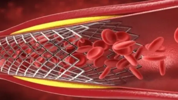 تحذير لمرضى القلب.. 4 علامات تكشف انسداد الشرايين وطرق الوقاية الفعالة