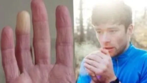 مرضى الأمراض المزمنة: كيف يحول الشتاء نزلات البرد العادية إلى أزمة صحية خطيرة؟