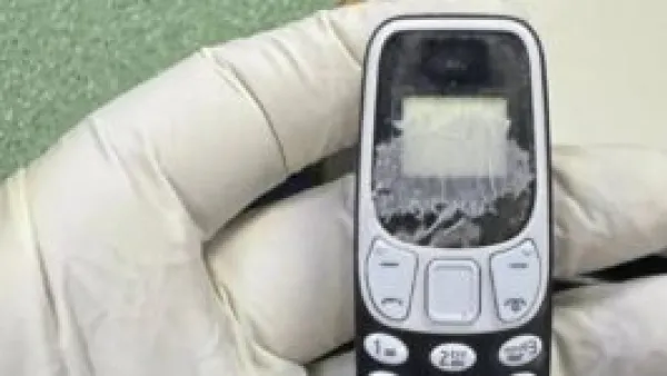 استخراج هاتف محمول من بطن مريض بعد 11 شهرا بمركز الجهاز الهضمي بالمنصورة