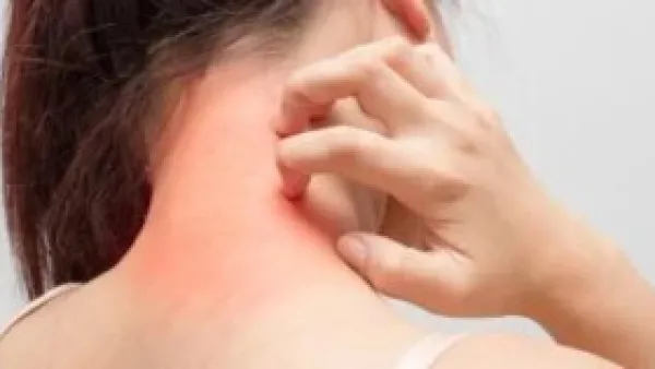 علاج الصدفية لم يعد يقتصر على الجلد.. خيارات حديثة تستهدف جذور المرض