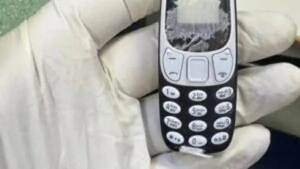 فريق طبي ينجح في استخراج هاتف محمول من بطن مريض ظل داخله 11 شهرا