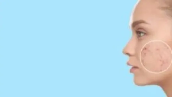 حب الشباب بعد الثلاثين: حين تكون الهرمونات هي المتهم الأول وليس إهمال البشرة.