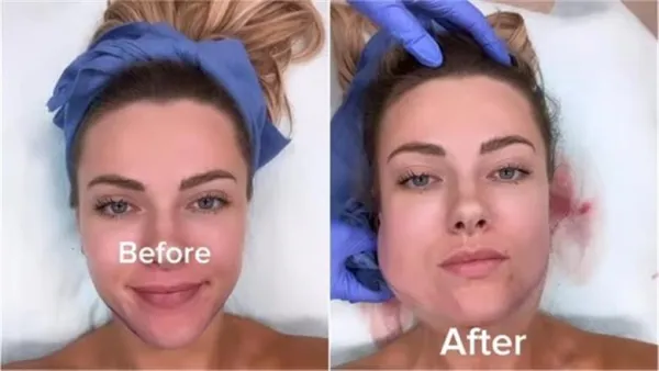 تحذير إبسن بروك.. كيف دمرت عمليات التجميل ملامح الفتاة بسبب هوس الفلاتر؟