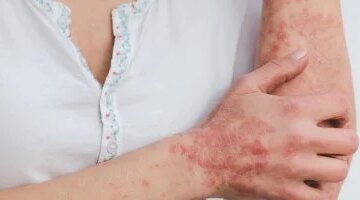 تهدئة نوبات الصدفية الحادة علاجات منزلية فعالة أقرها أطباء الجلدية