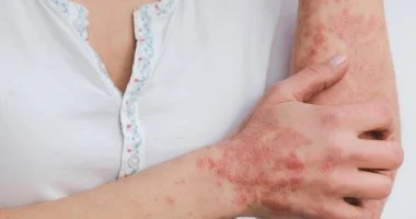 تهدئة نوبات الصدفية الحادة.. علاجات منزلية فعالة أقرها أطباء الجلدية