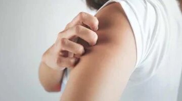 خمسة تعديلات غذائية للتحكم في أعراض الصدفية وتخفيف تهيج الجلد