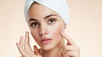 السيطرة على حب الشباب الموسمي 5 تعديلات بسيطة يوصي بها